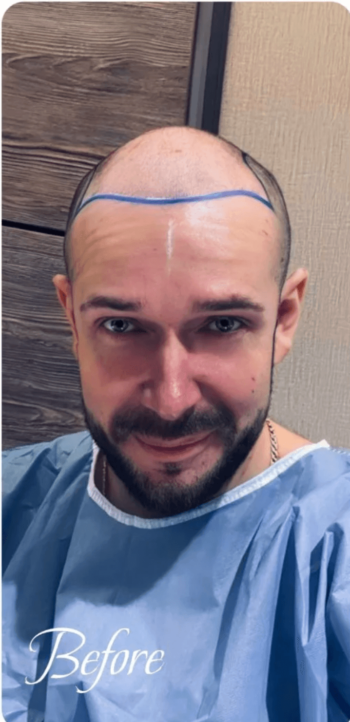 Hair Transplant - Before
