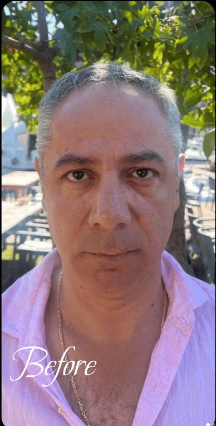 Hair Transplant - Before