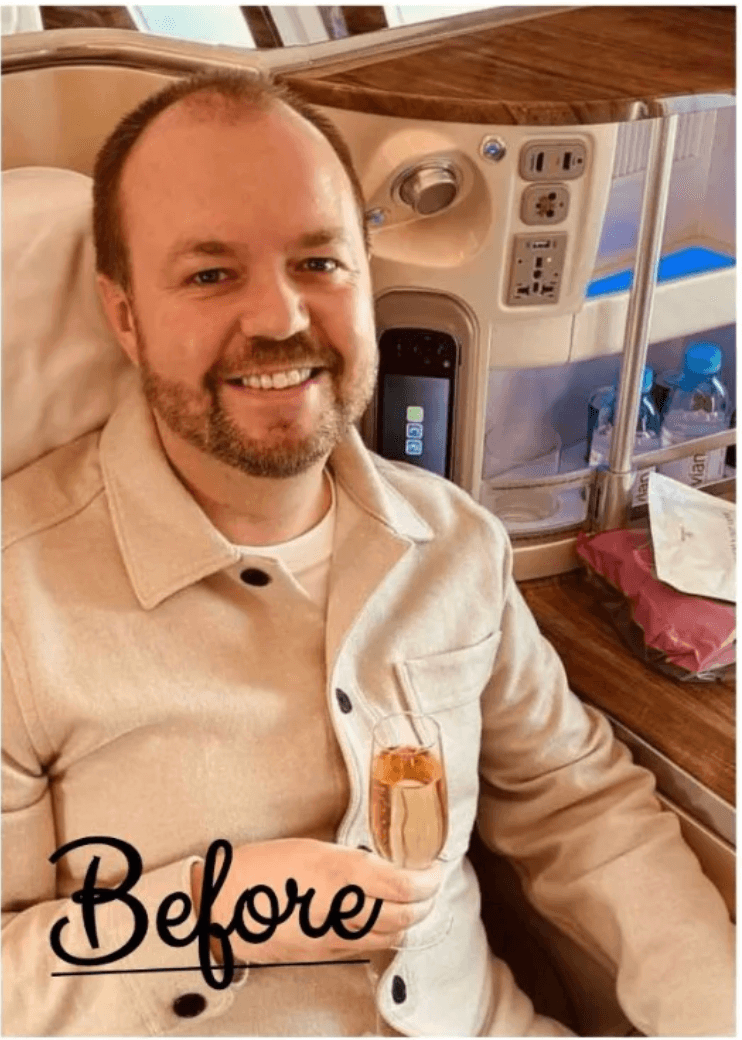 Hair Transplant - Before