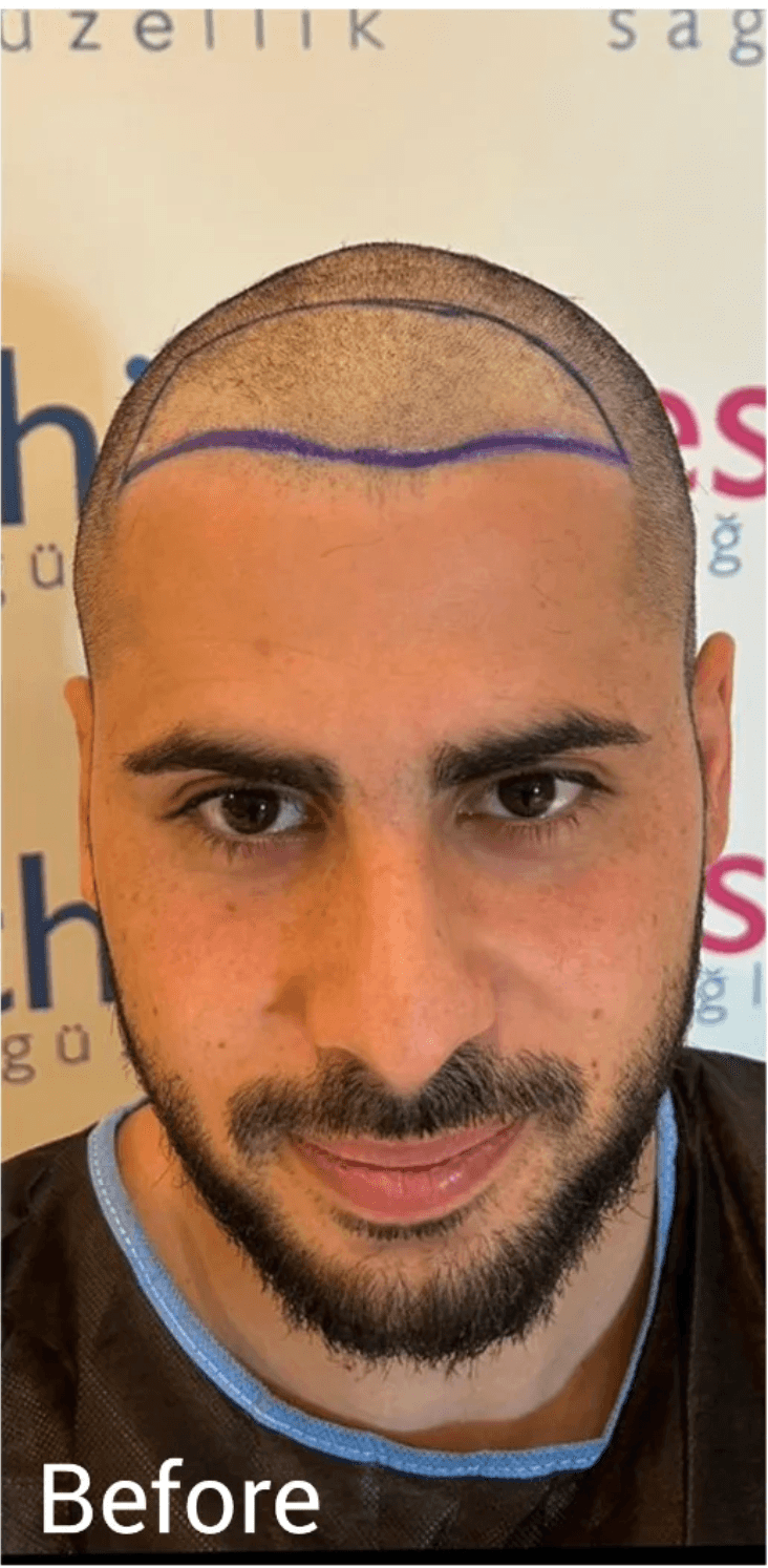 Hair Transplant - Before