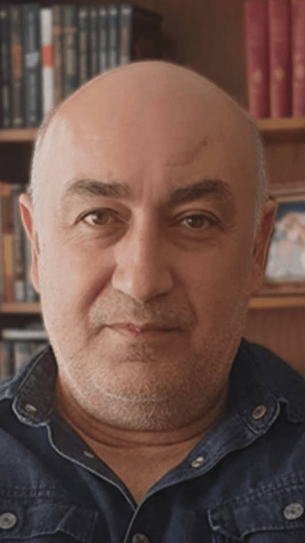 Hair Transplant - Before