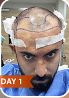 Hair Transplant - Before