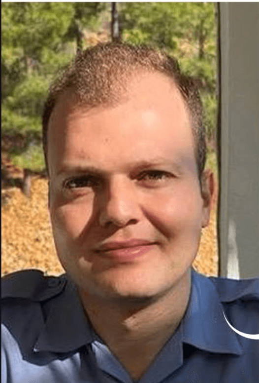 Hair Transplant - Before