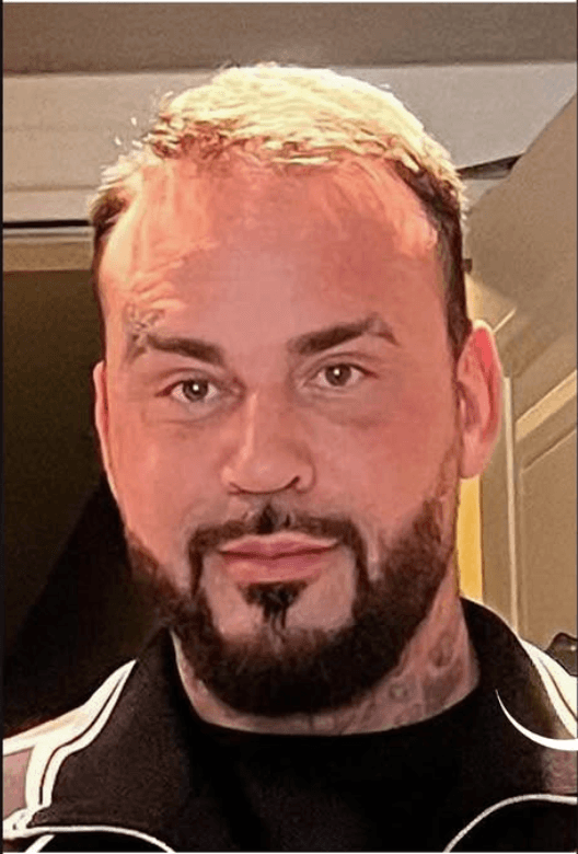 Hair Transplant - Before