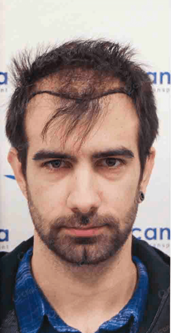 Hair Transplant - Before