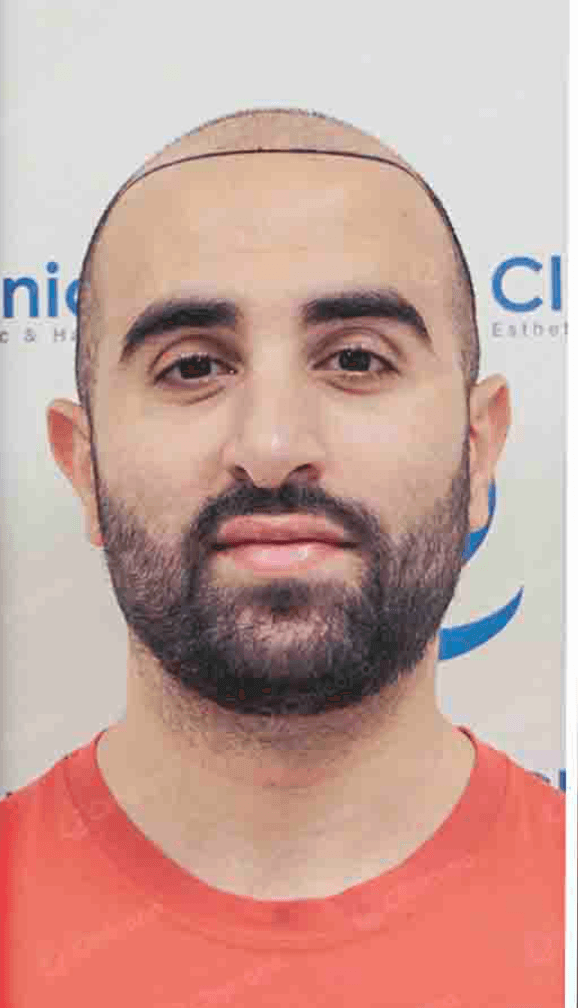 Hair Transplant - Before