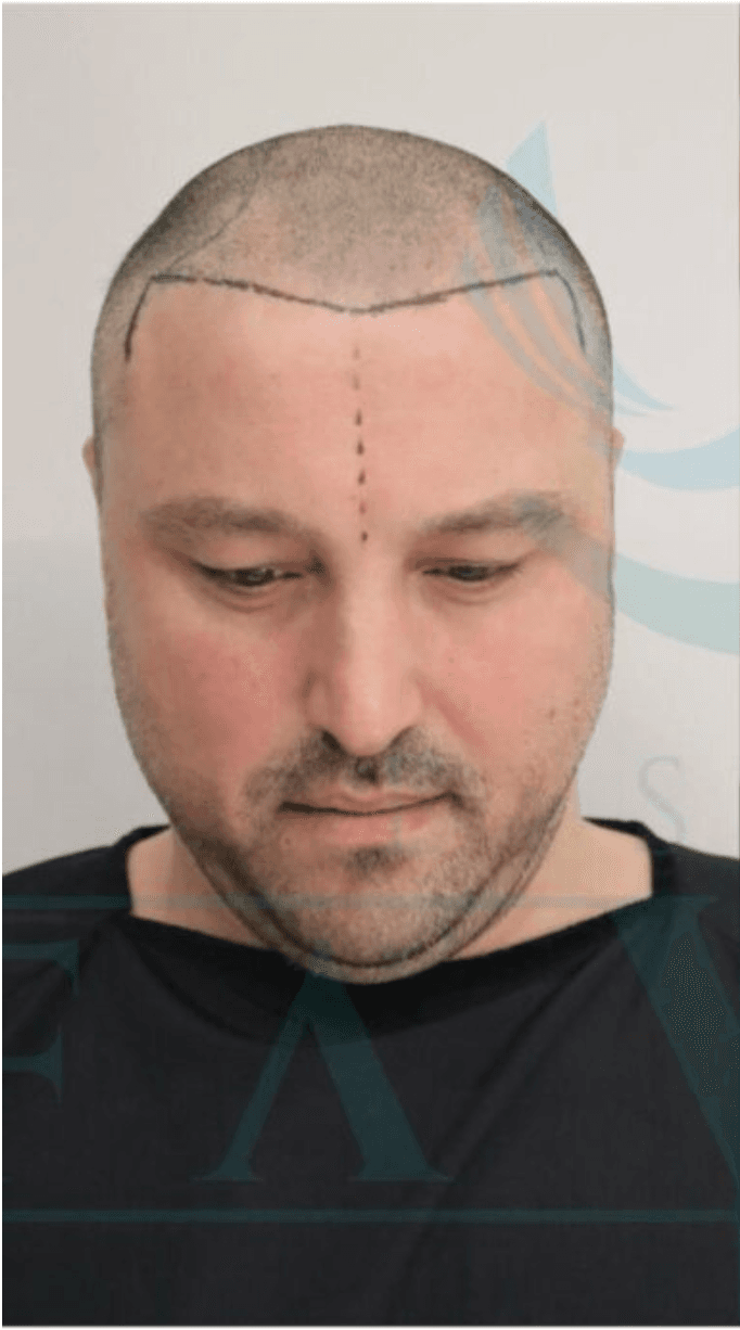 Hair Transplant - Before