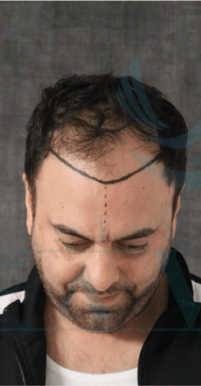 Hair Transplant - Before