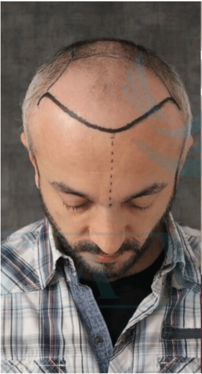 Hair Transplant - Before