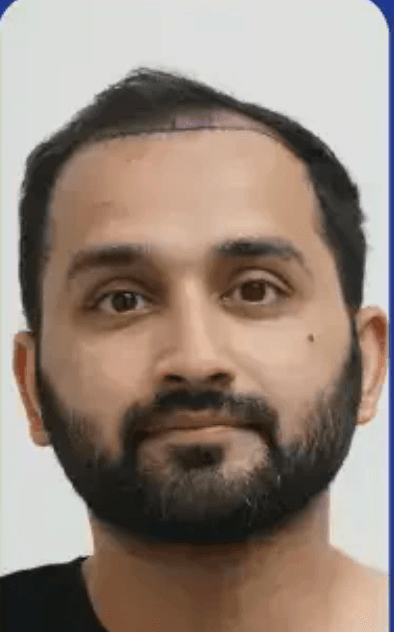 Hair Transplant - Before