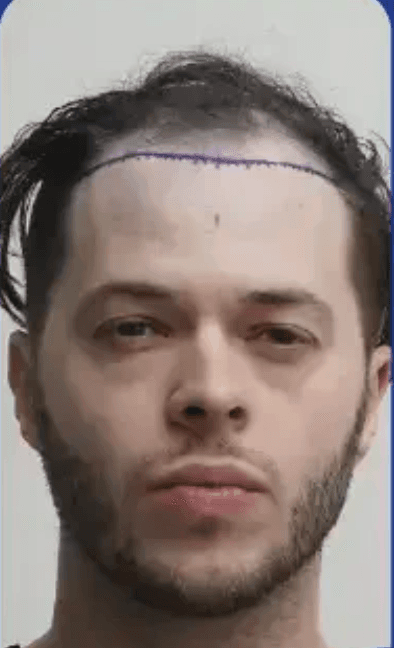 Hair Transplant - Before