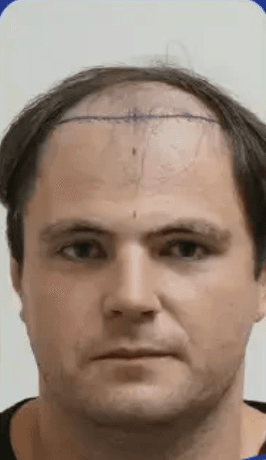 Hair Transplant - Before