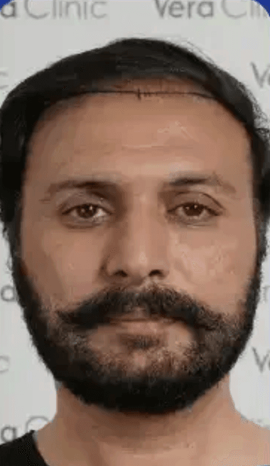 Hair Transplant - Before