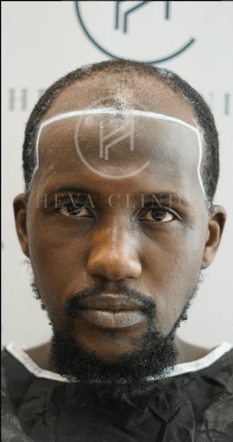 Fue Hair Transplant - Before