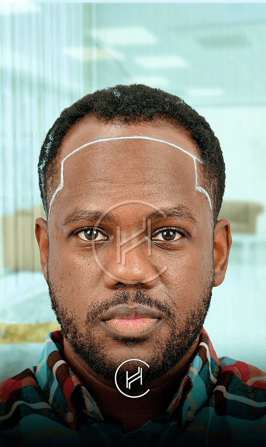 Fue Hair Transplant - Before