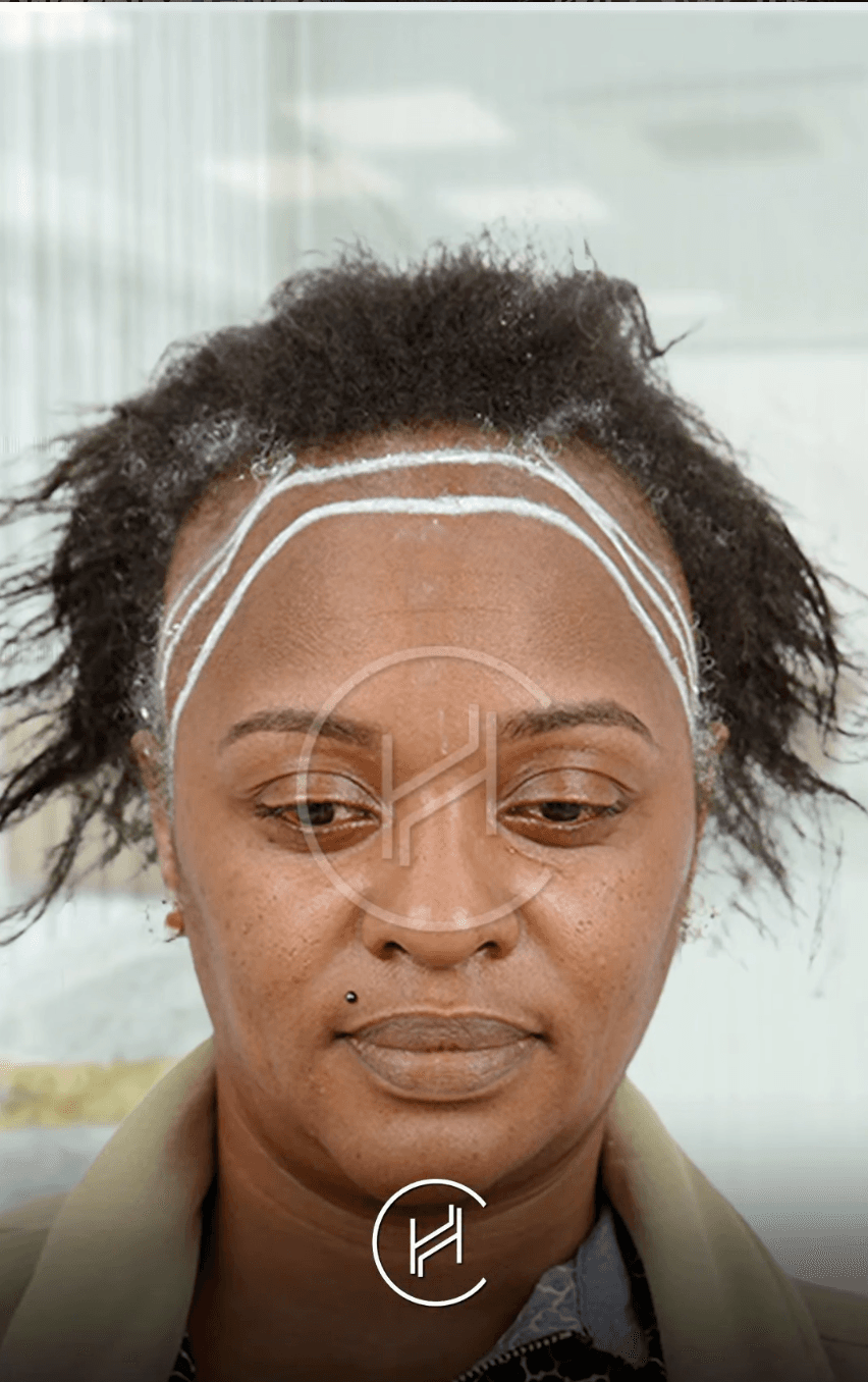 Women Fue Hair Transplant - Before