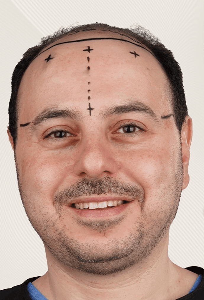 Hair Transplant - Before