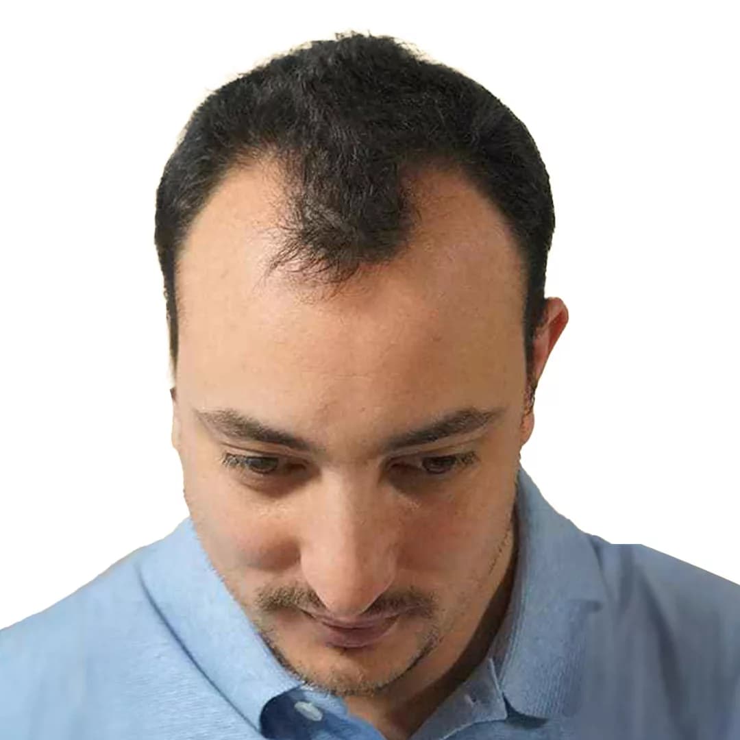 Hair Transplant - Before