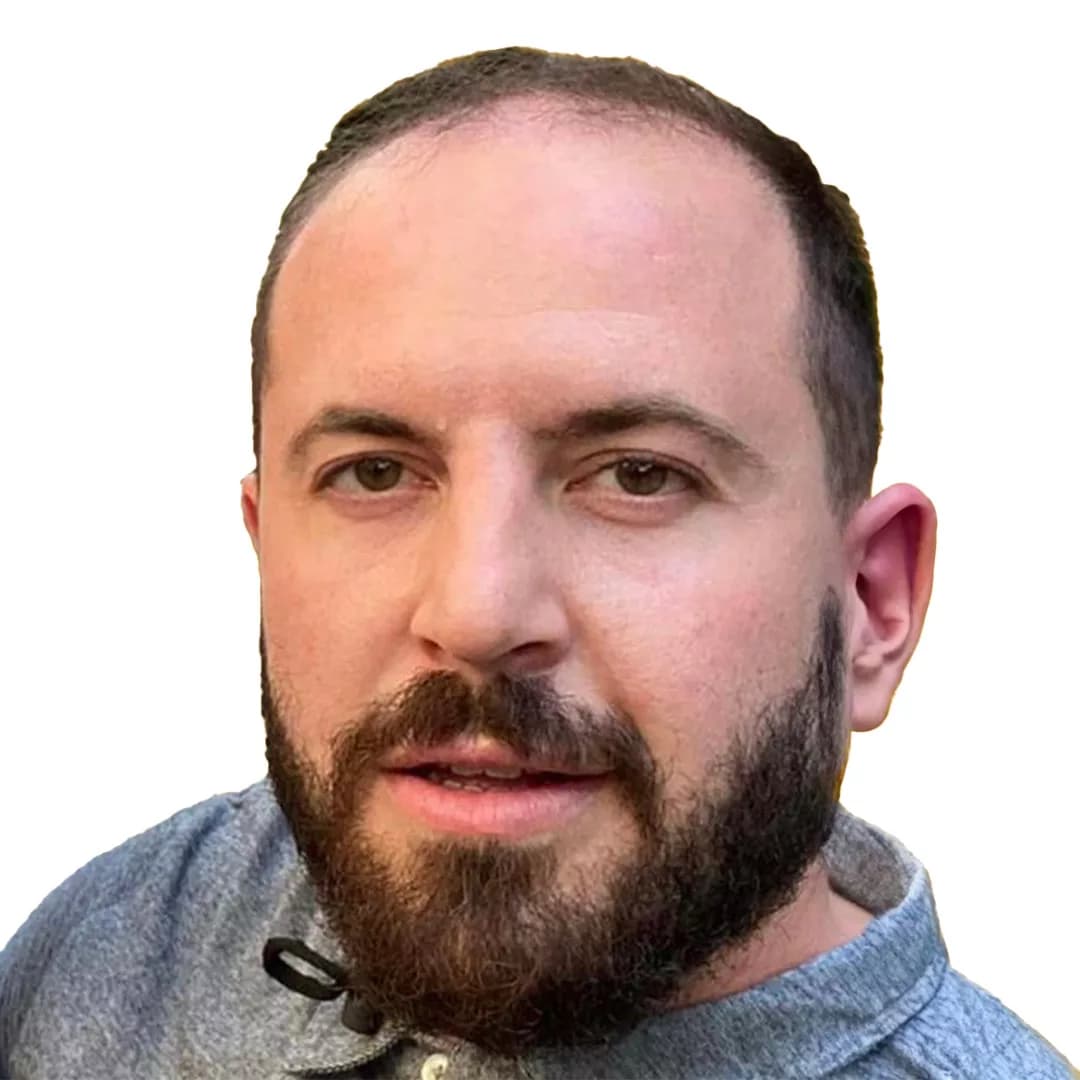 Hair Transplant - Before