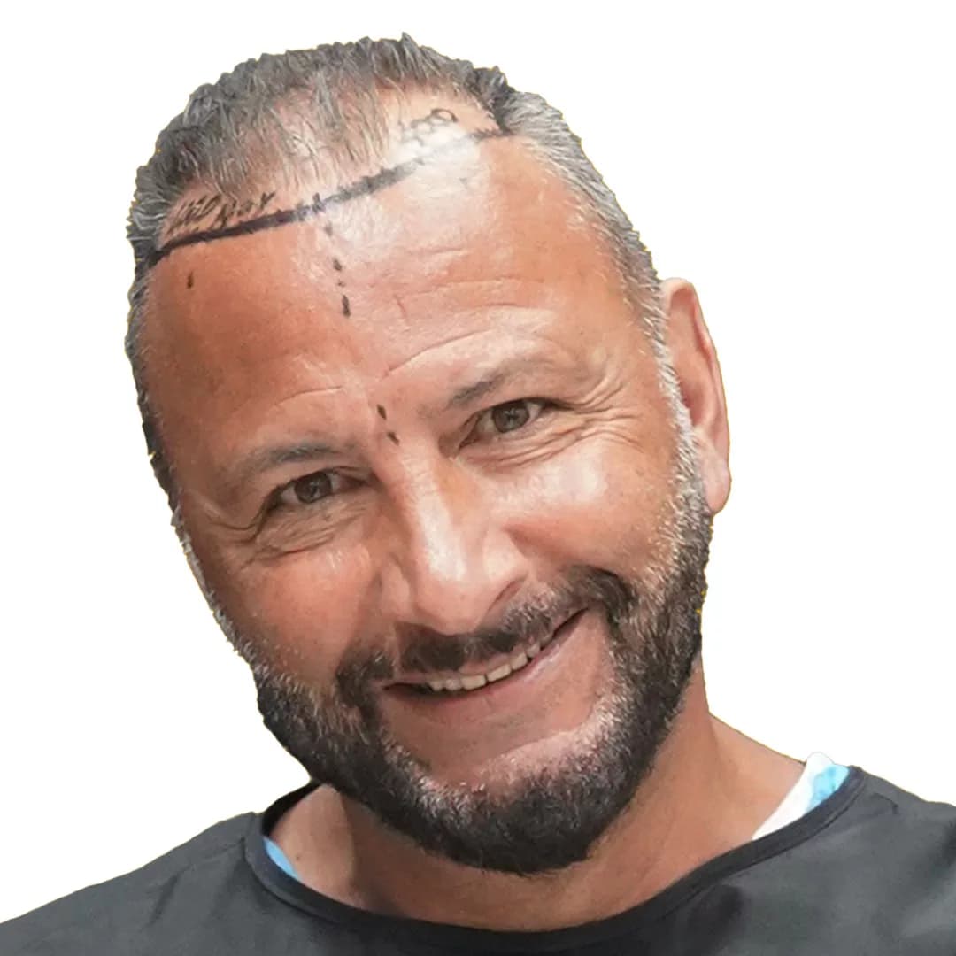 Hair Transplant - Before