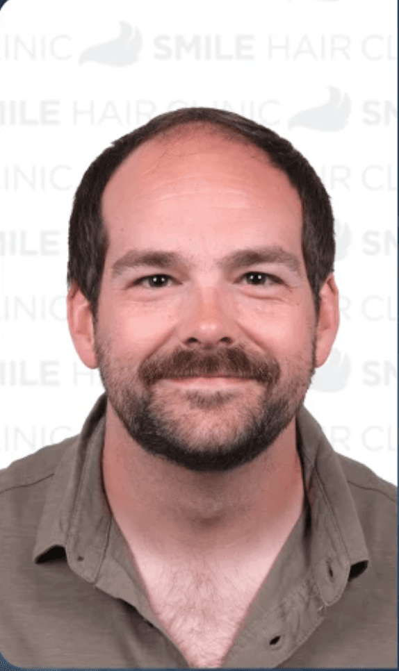 Hair Transplant - Before