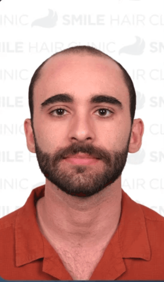 Hair Transplant - Before