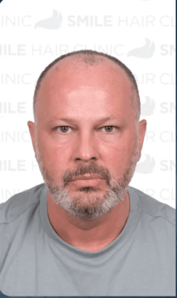 Hair Transplant - Before