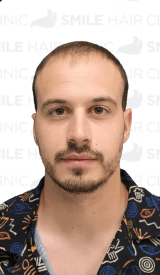 Hair Transplant - Before