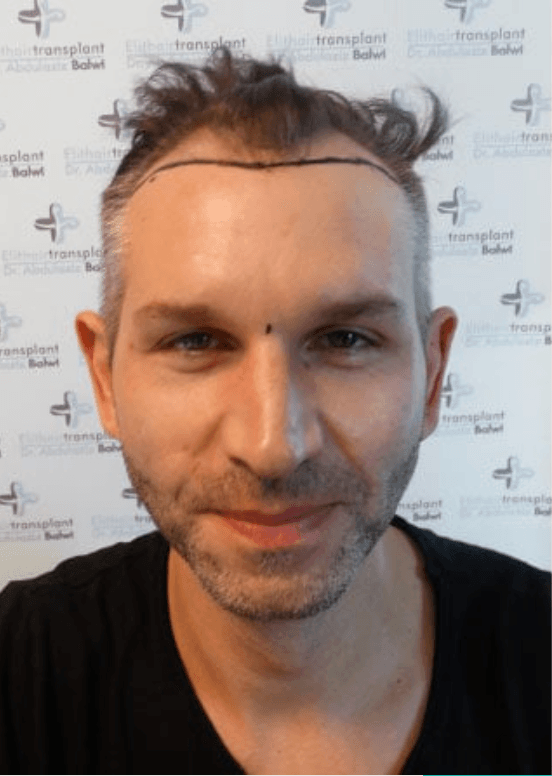 Hair Transplant - Before