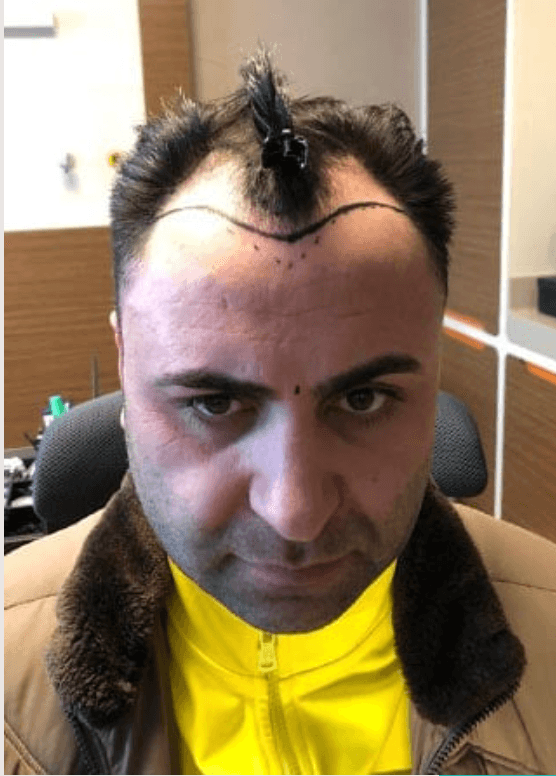 Hair Transplant - Before