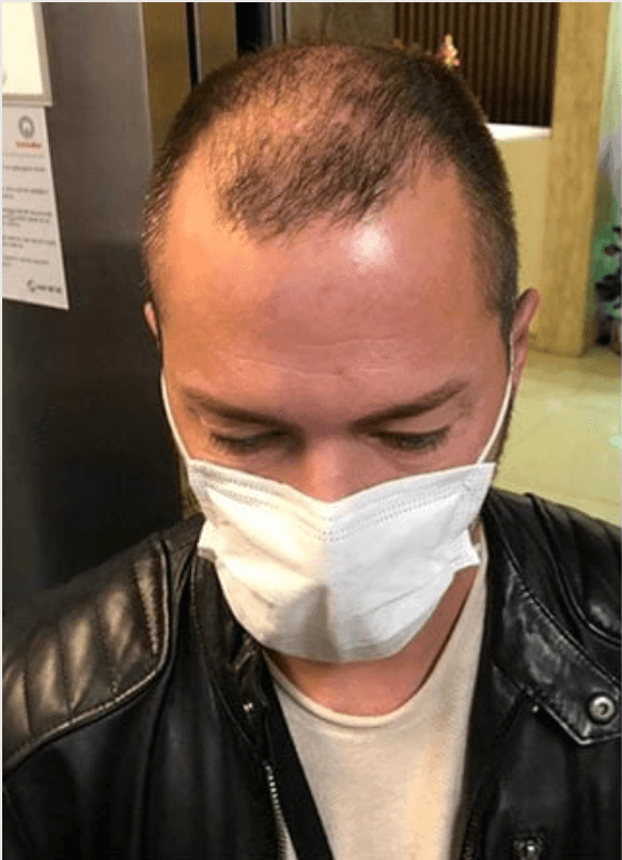 Hair Transplant - Before