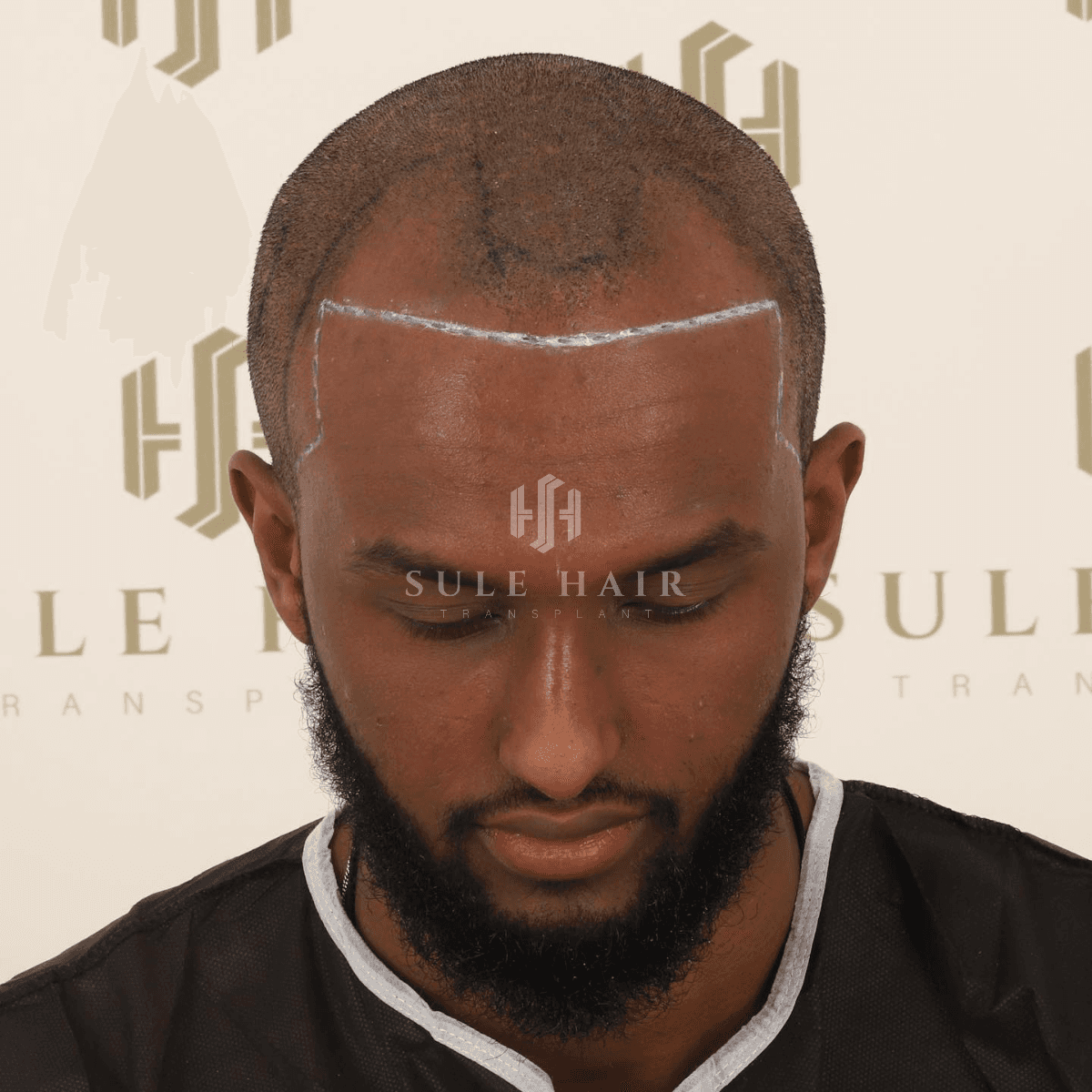 Hair Transplant - Before
