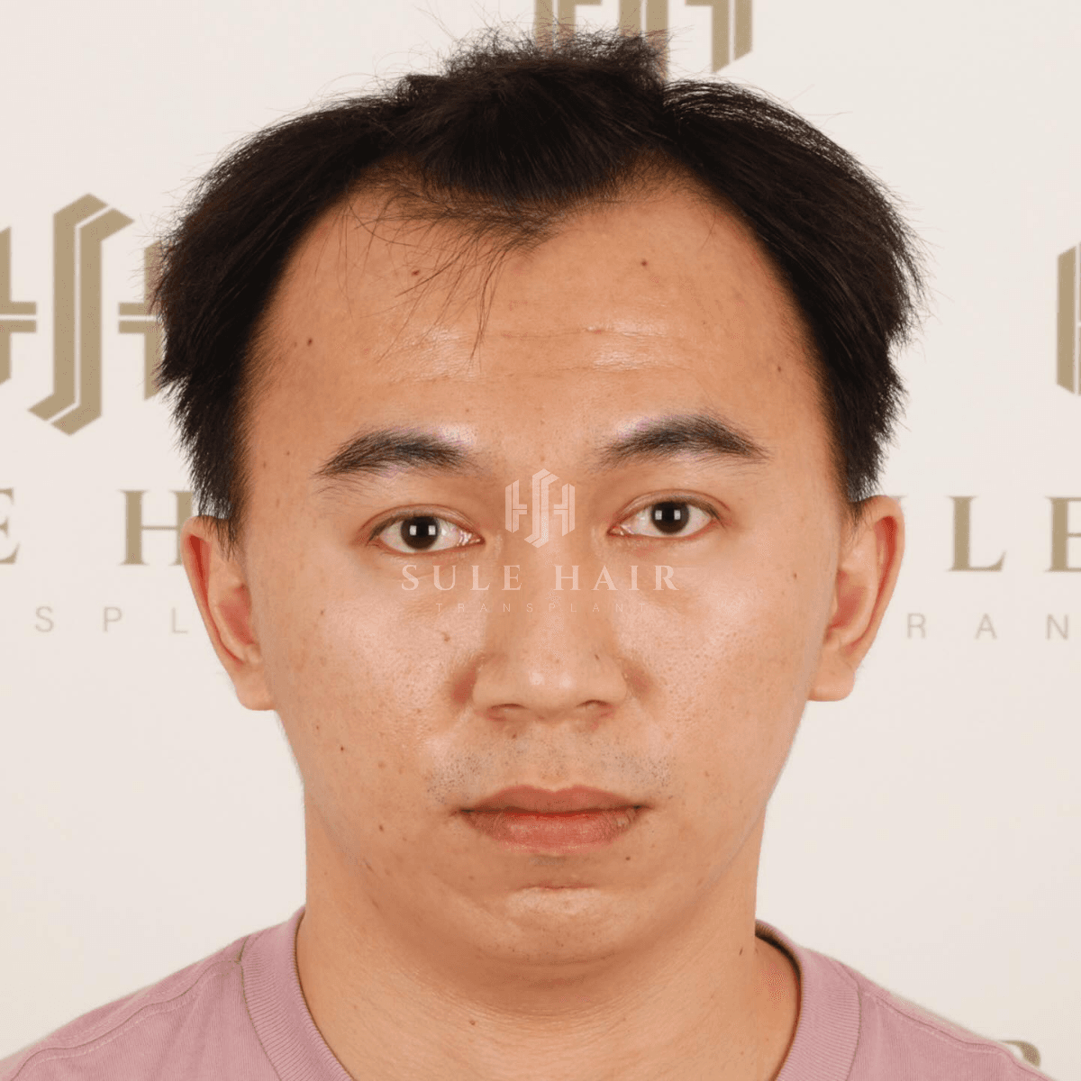 Hair Transplant - Before