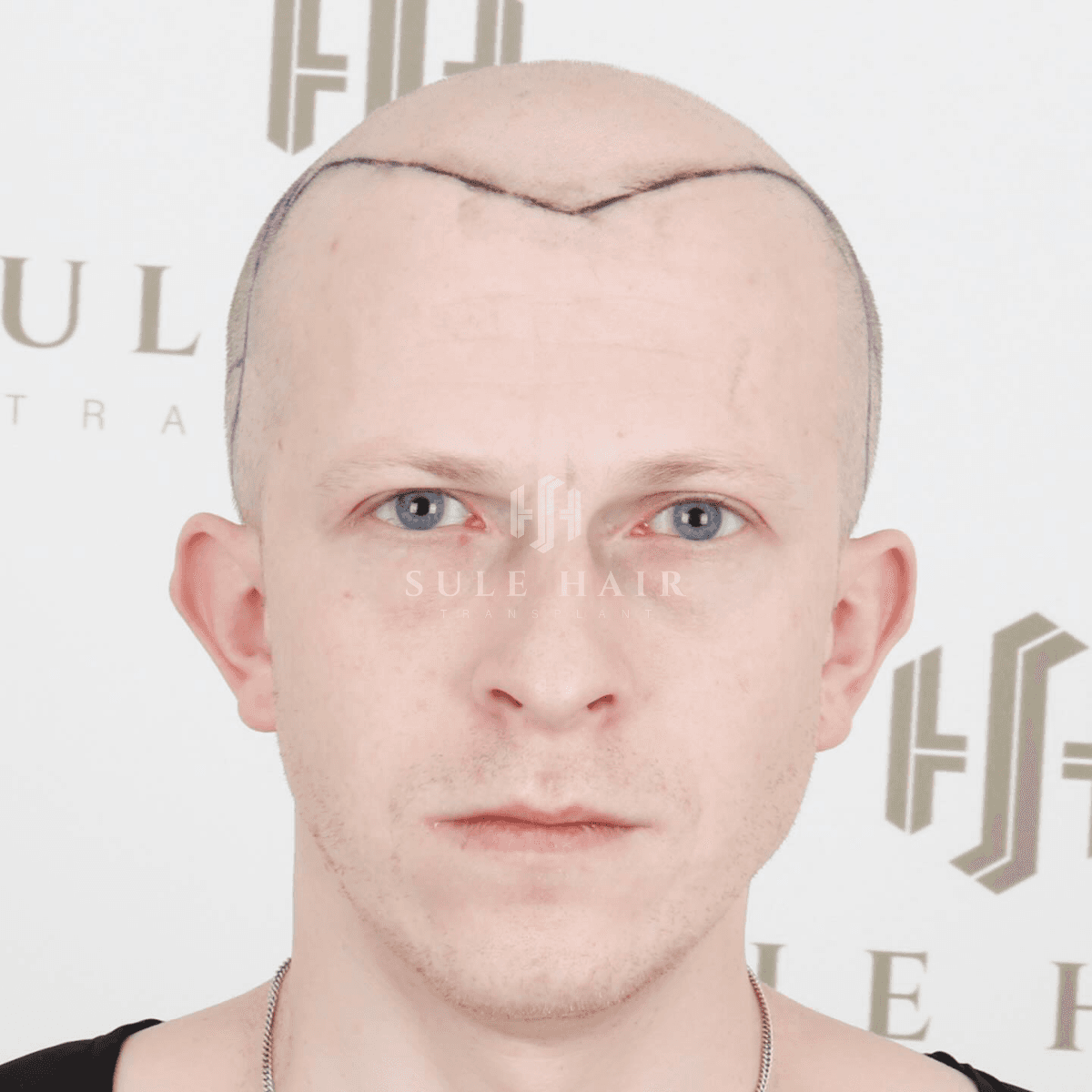 Hair Transplant - Before