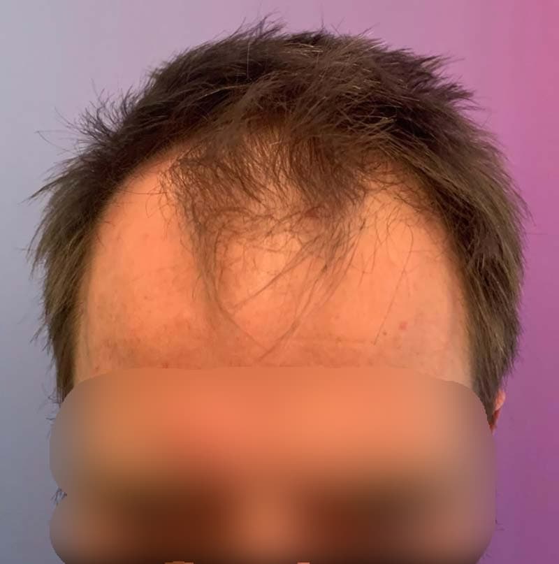 micromotor FUE - Before