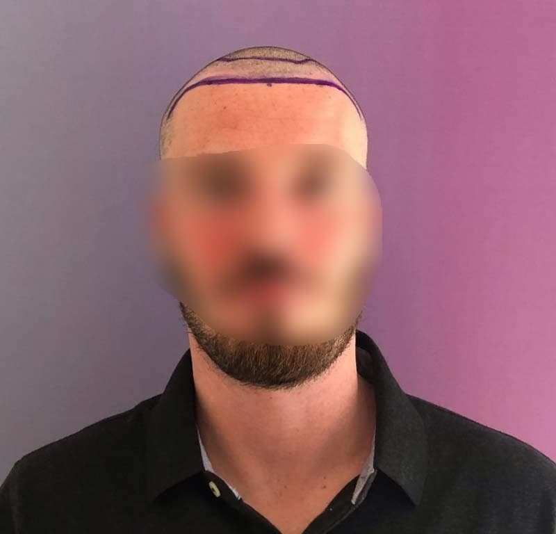 micromotor FUE - Before