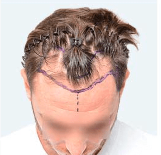 Hair Transplant - Before
