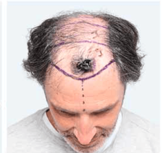 Hair Transplant - Before