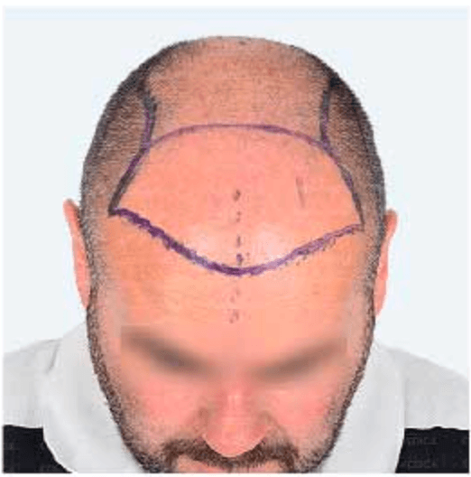 Hair Transplant - Before
