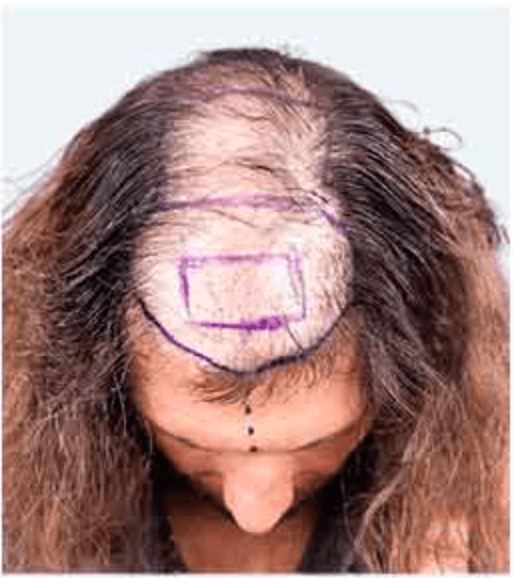 Hair Transplant - Before