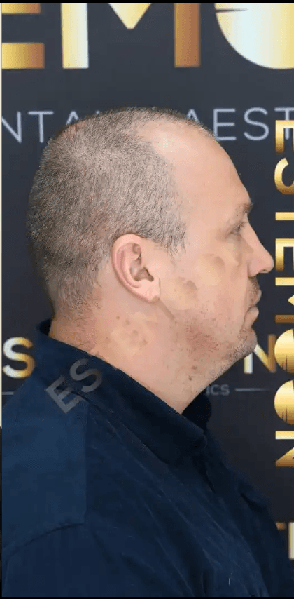 Hair Transplant - Before