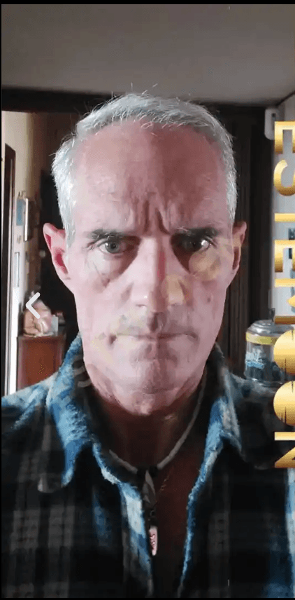 Hair Transplant - Before