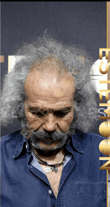 Hair Transplant - Before