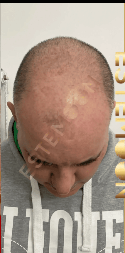 Hair Transplant - Before