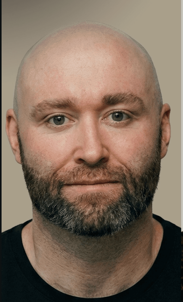 DHI Hair Transplant - Before