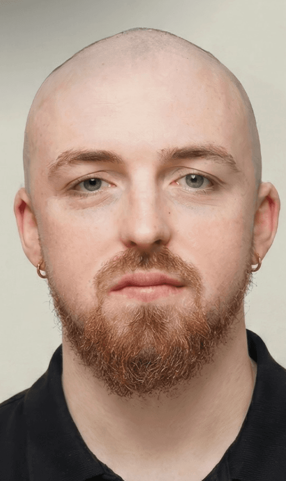 FUE Hair Transplant - Before