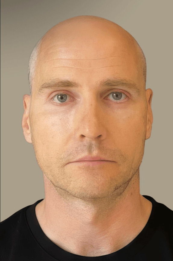 FUE Hair Transplant - Before