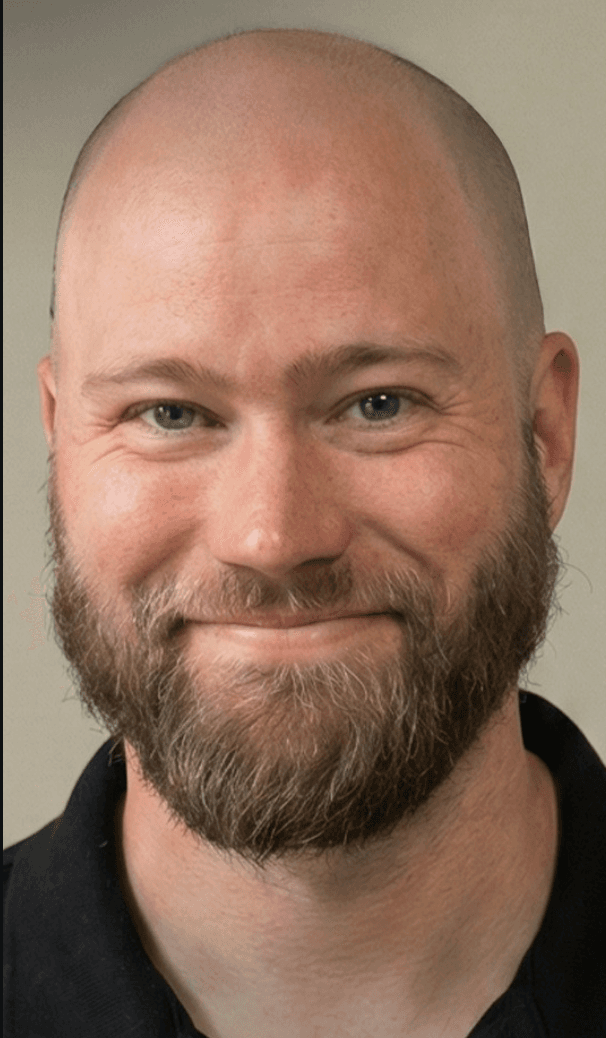 DHI Hair Transplant - Before