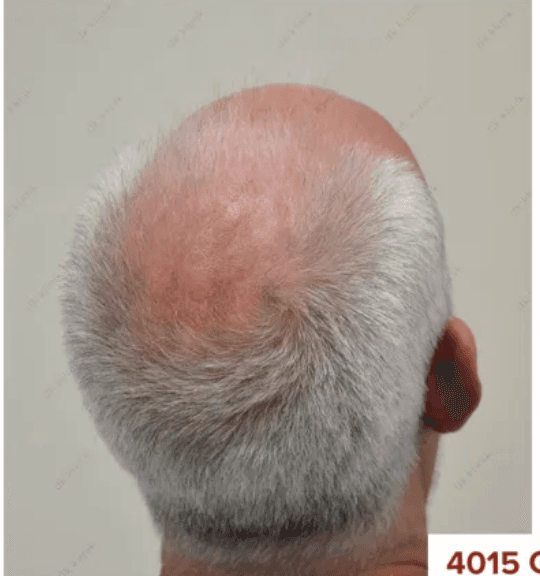 Hair Transplant - Before