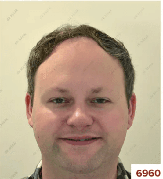 Hair Transplant - Before